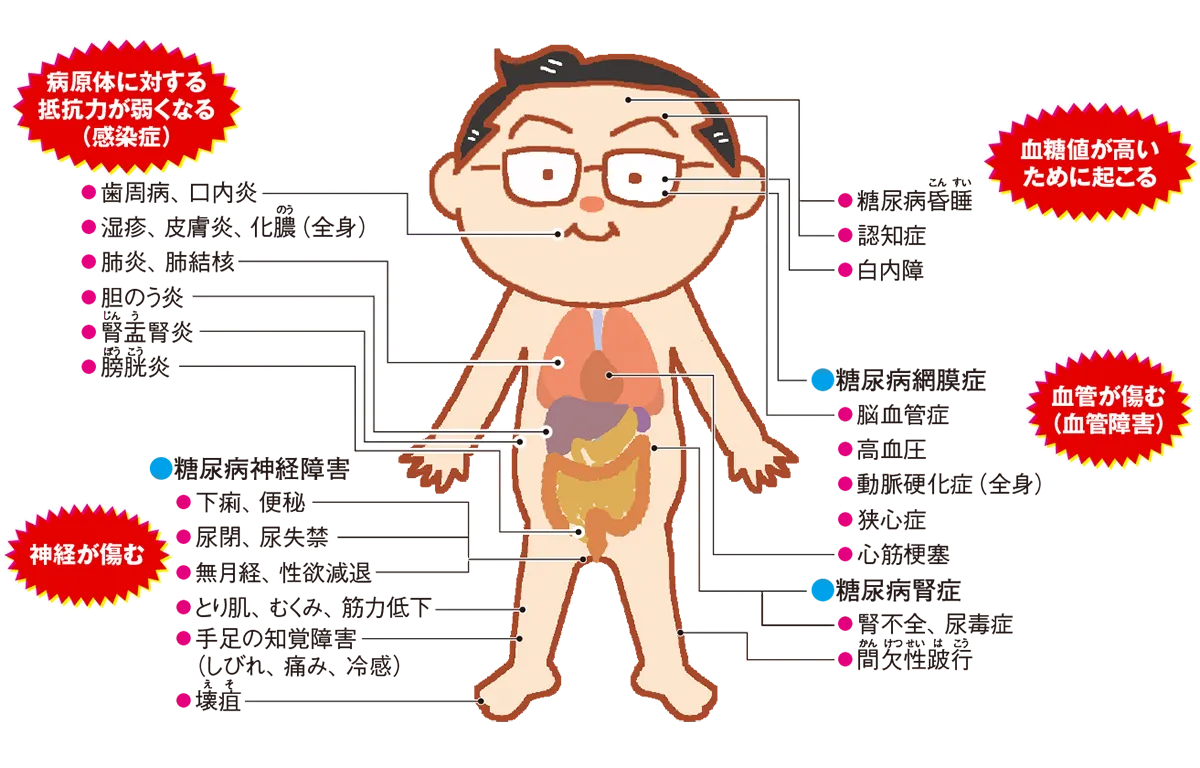 図解:全身に及ぶ糖尿病の合併症