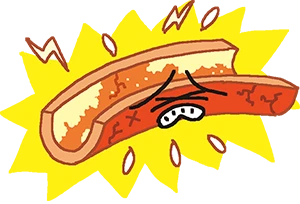 イラスト:動脈硬化